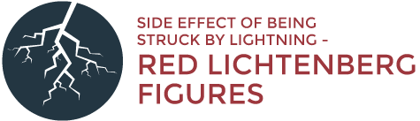 Side effect of being struck by lightning - Red Lichtenberg